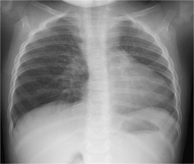Case report: Unilateral pulmonary artery agenesis and Kommerell's diverticulum in 1-year old girl